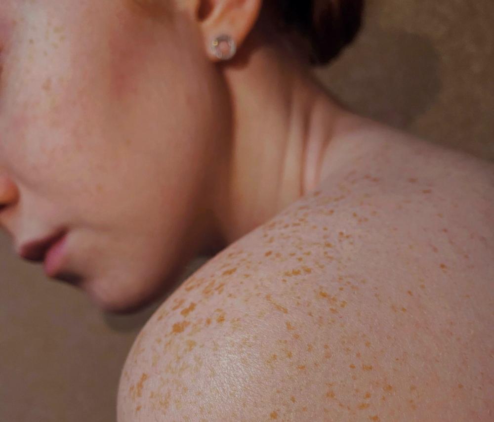 peau tâche de rousseur